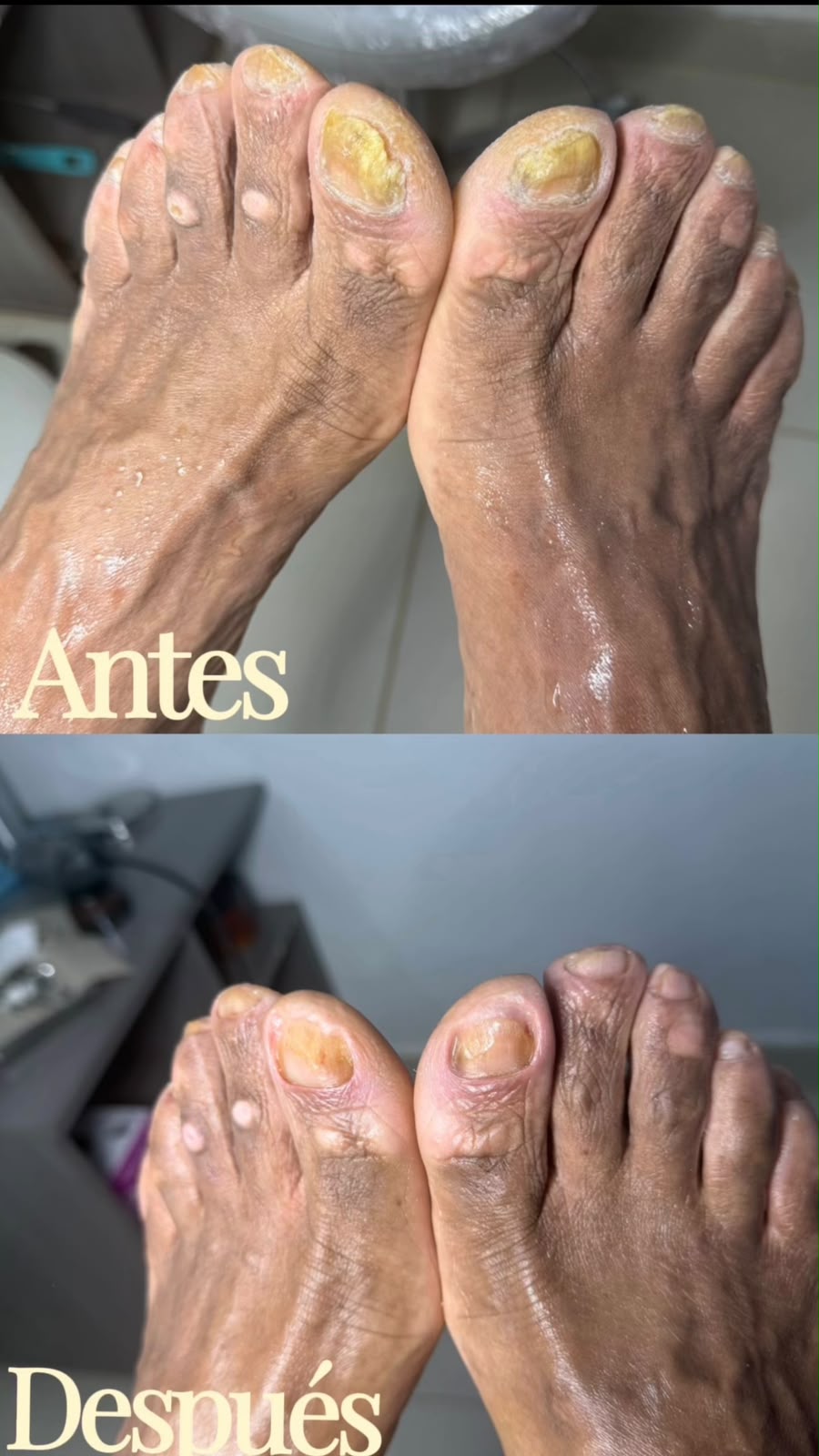 Antes y después del tratamiento de hongos en las uñas de ambos pies
