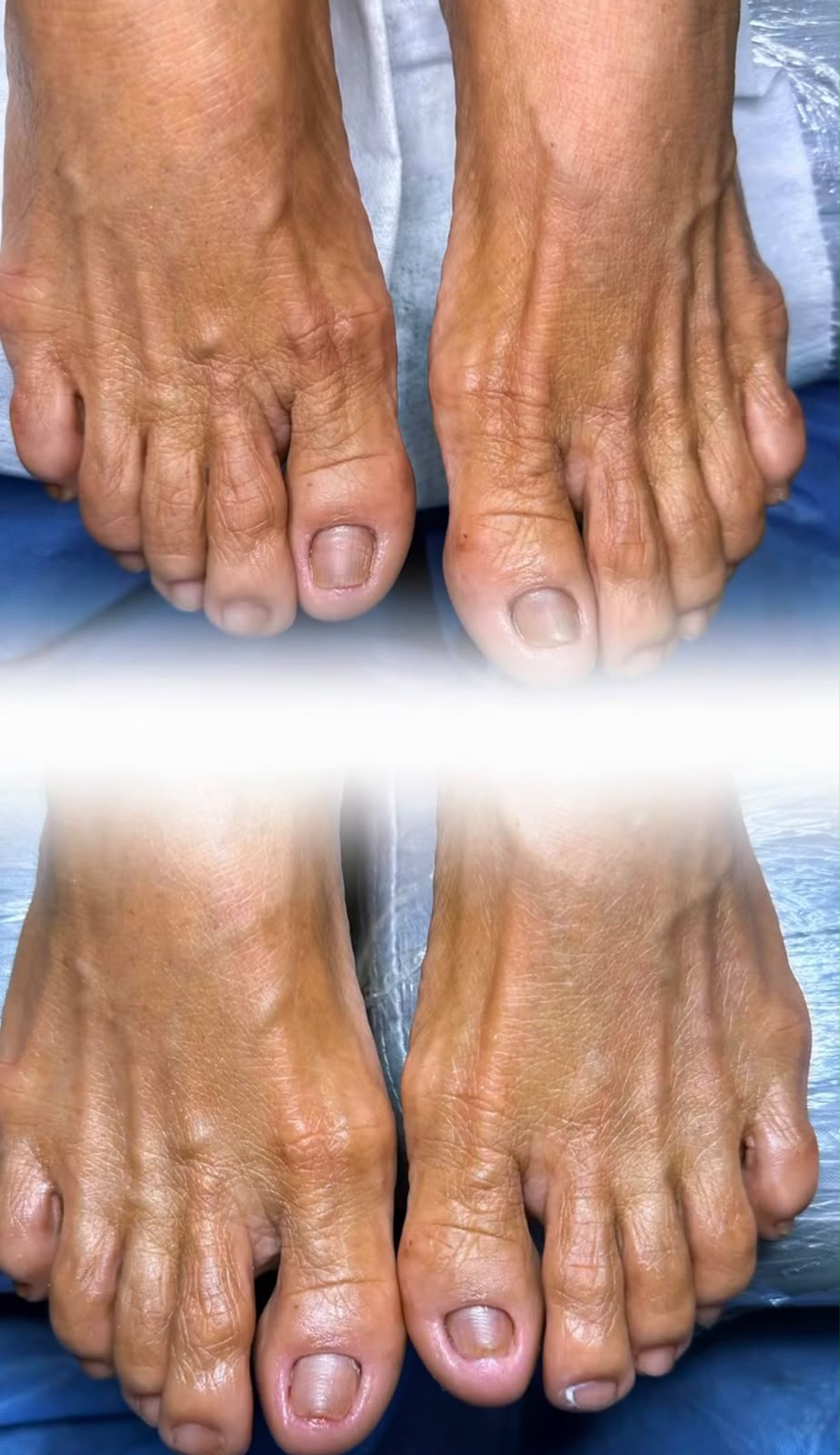 Antes y después de pedicura clínica e higiene de uñas en un paciente adulto mayor