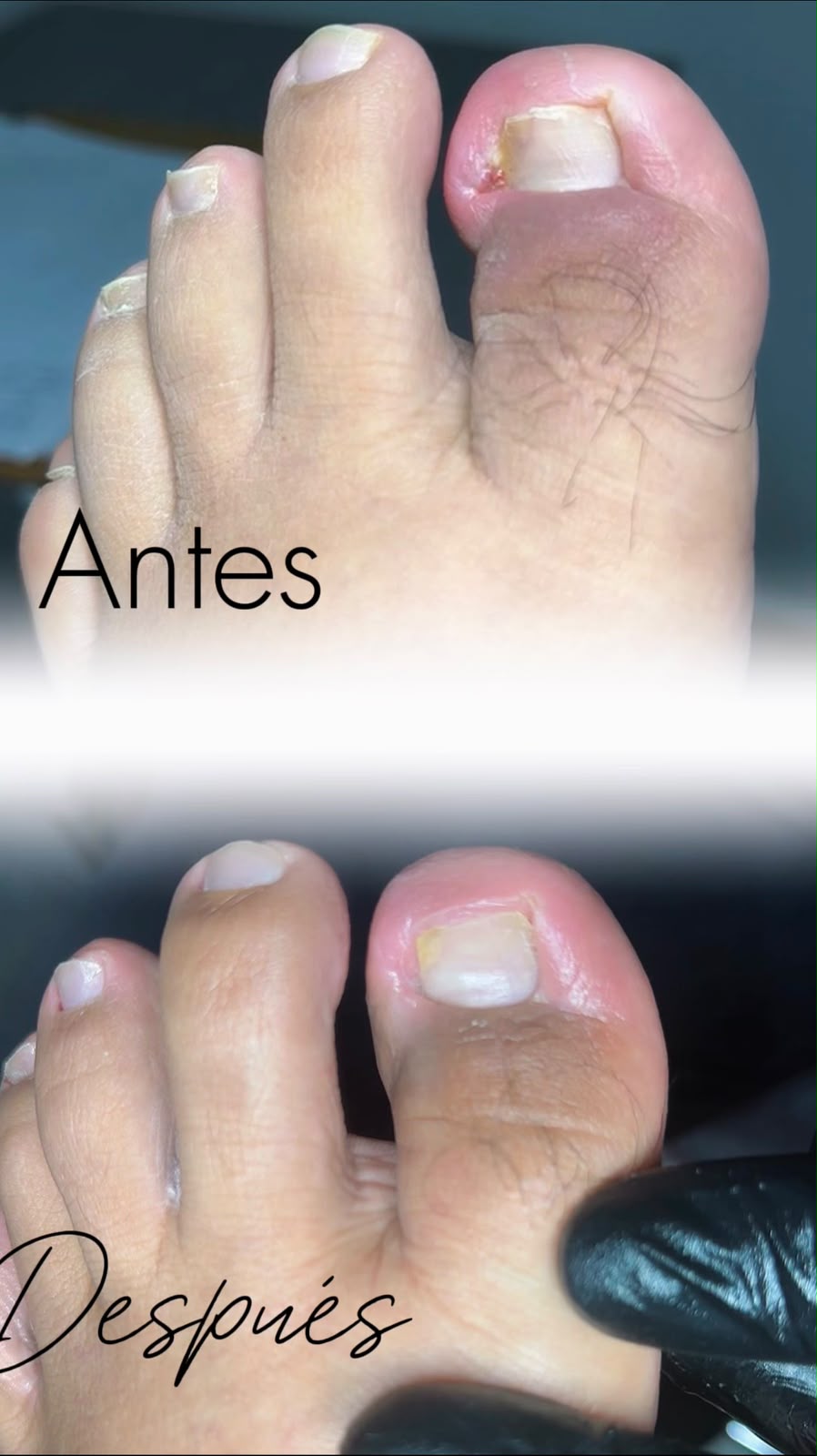Antes y después del tratamiento de una uña encarnada en el dedo gordo del pie