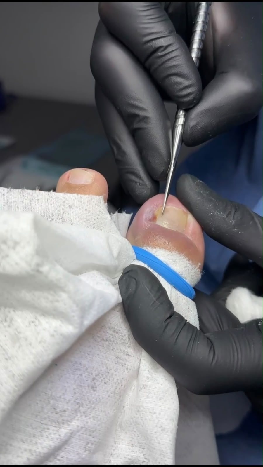 Procedimiento profesional para retirar una uña encarnada del dedo gordo